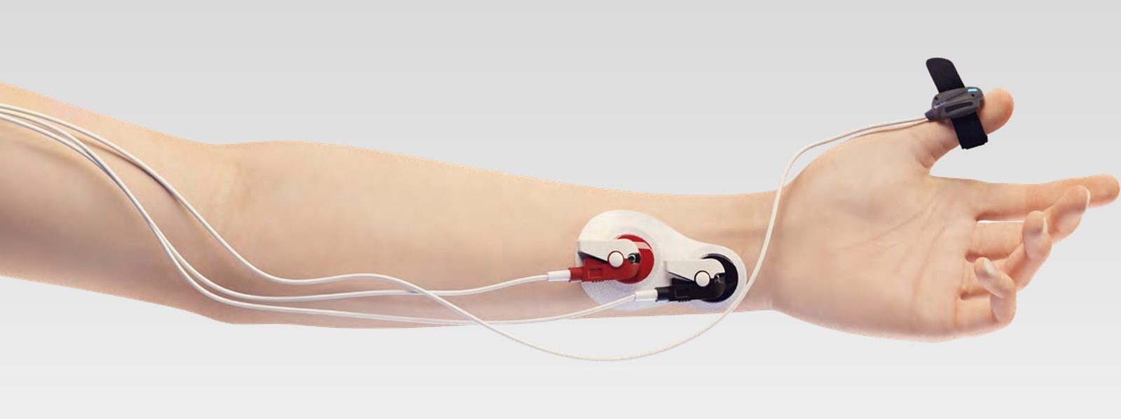 Acceleromyography setup on a forearm: two skin electrodes over the ulnar nerve and a reusable accelerometer strapped to the thumb