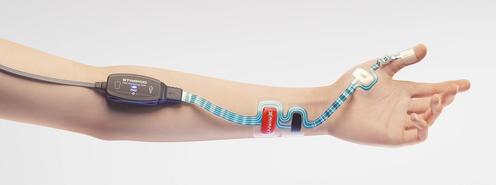 Electromyography setup on a forearm: the single-use ripple electrode array running from the wrist to the thumb, connected to the Stimpod NMT monitoring cable