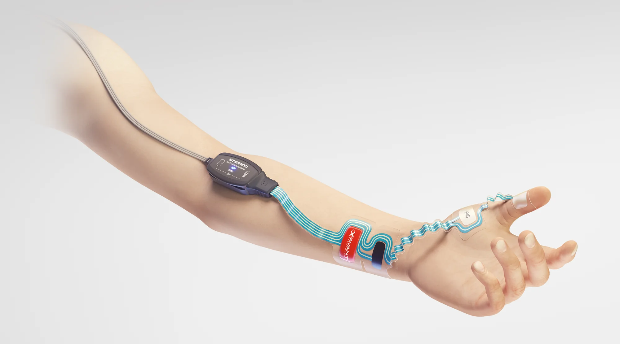 Stimpod-EMG-Ripple-Elektrode an einem Unterarm: Stimulationsfelder am Handgelenk, der Streifen verläuft zu einem Ableitfeld zwischen Daumen und Zeigefinger, Kabelmodul am Unterarm