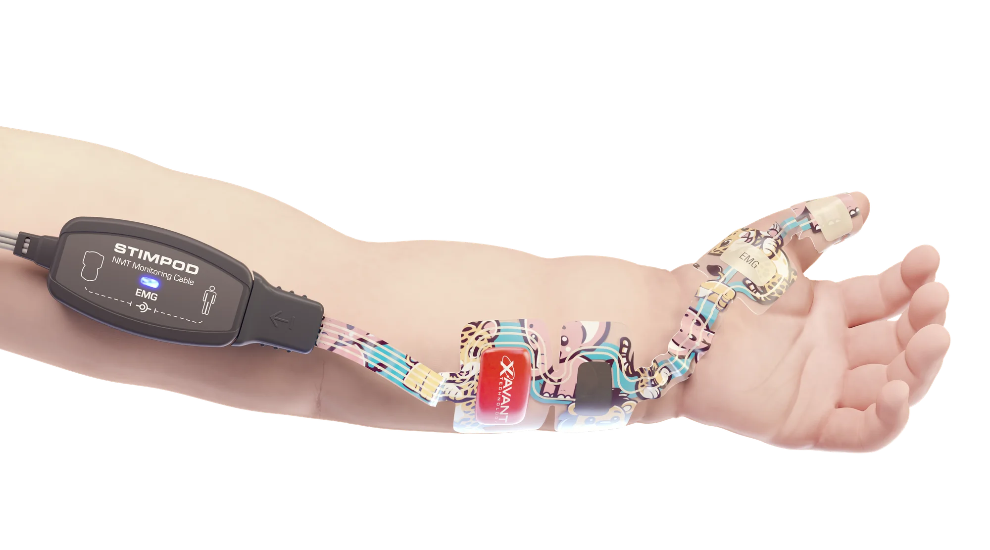 Kleine EMG-Elektrode entlang von Unterarm und Hand eines Kindes angebracht, verbunden mit dem Stimpod-EMG-Kabel