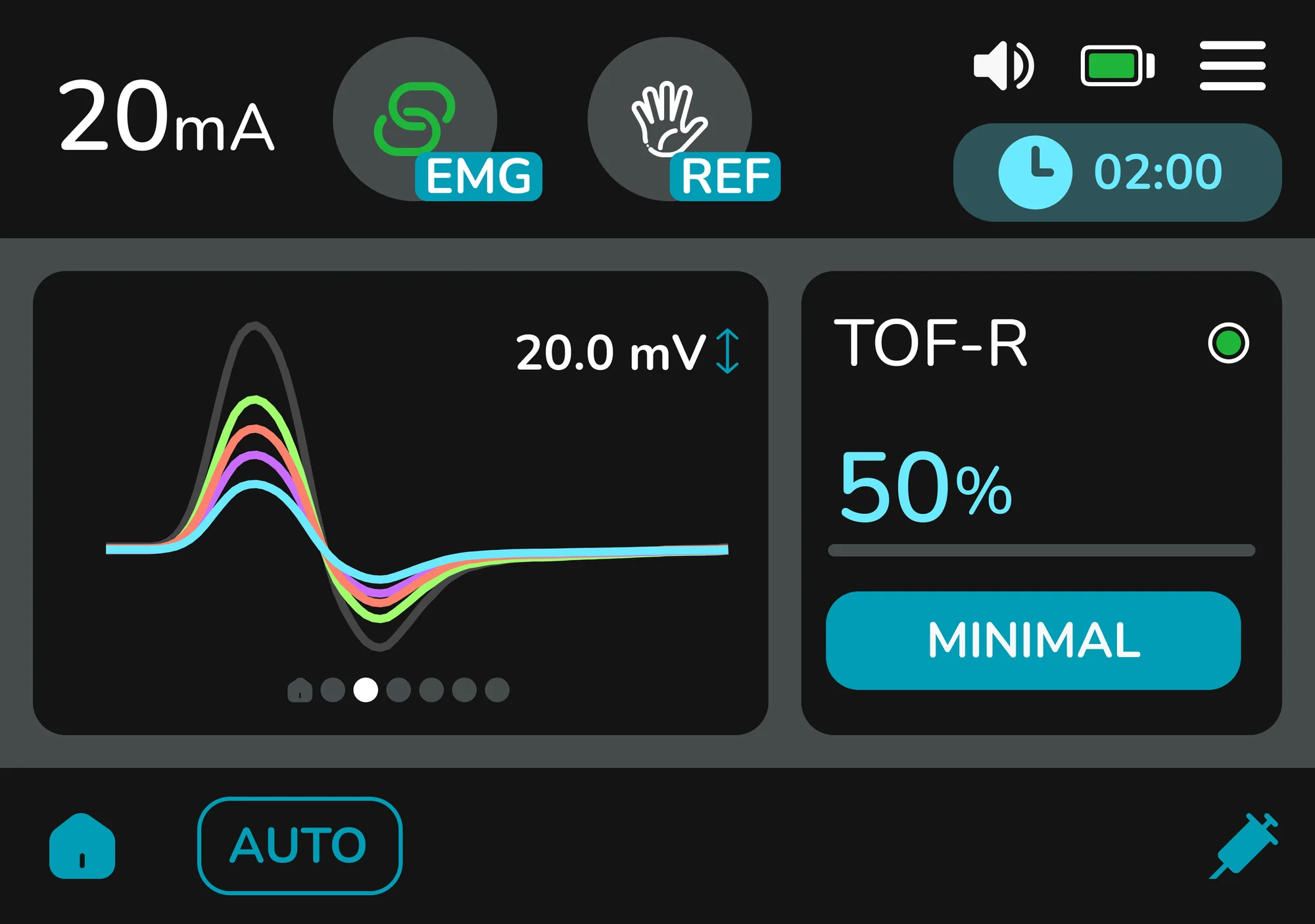 Bildschirm des Stimpod NMS450X+ im EMG-Modus: vier überlagerte Antwortkurven neben einer TOF-Ratio von 50 Prozent mit der Bezeichnung „minimal“